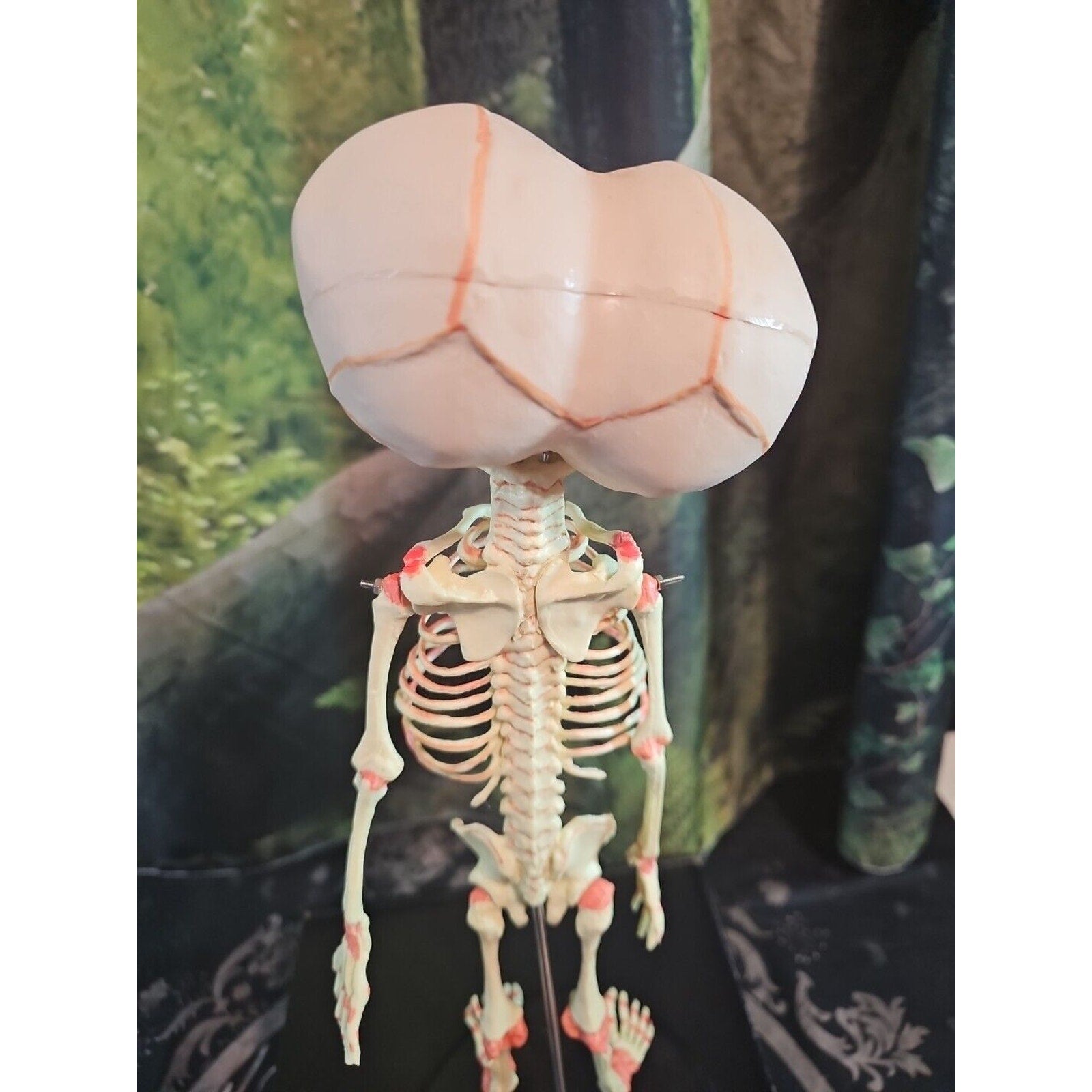 Pinyl vinyl chloride skeleton of abnormal infant