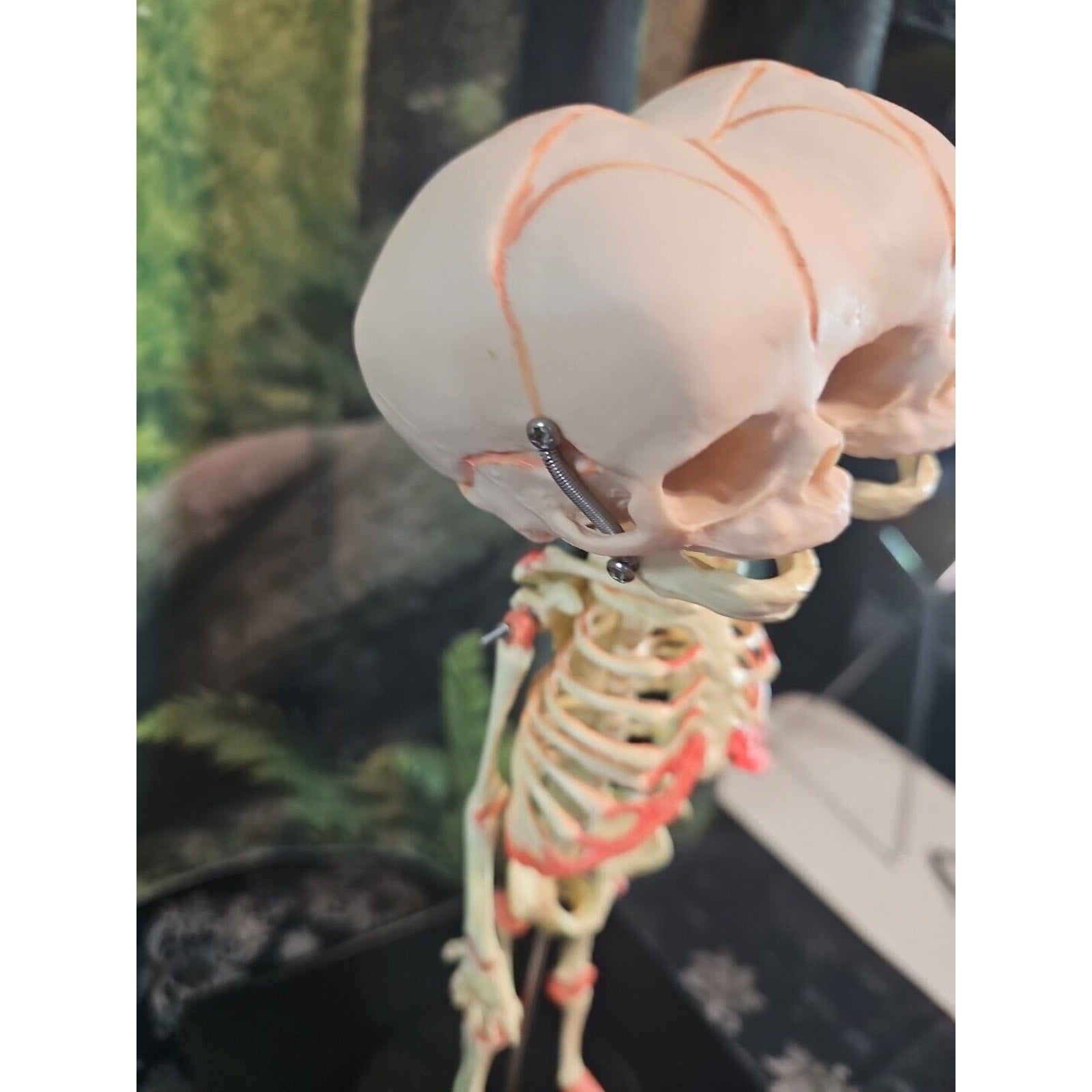 Pinyl vinyl chloride skeleton of abnormal infant