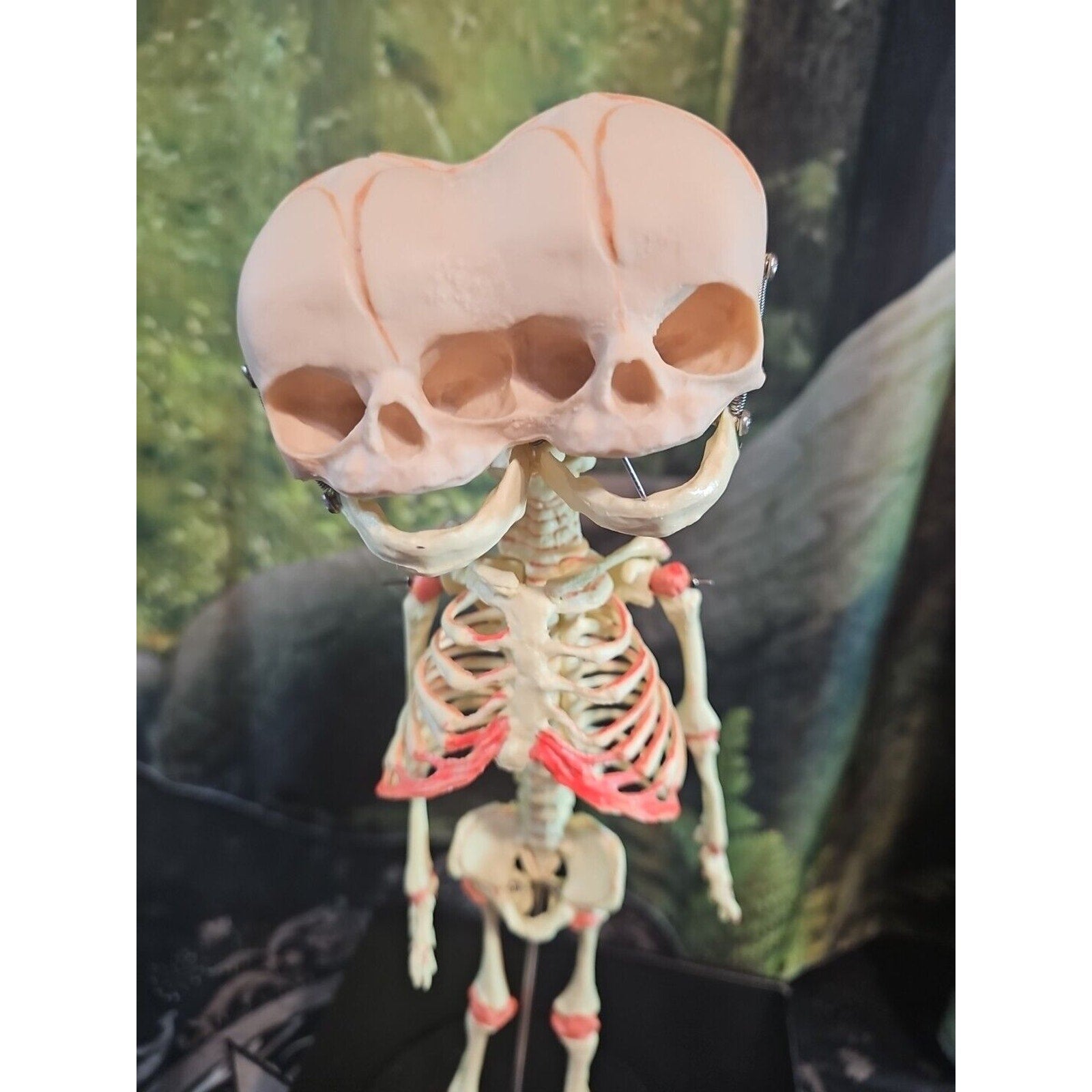 Pinyl vinyl chloride skeleton of abnormal infant