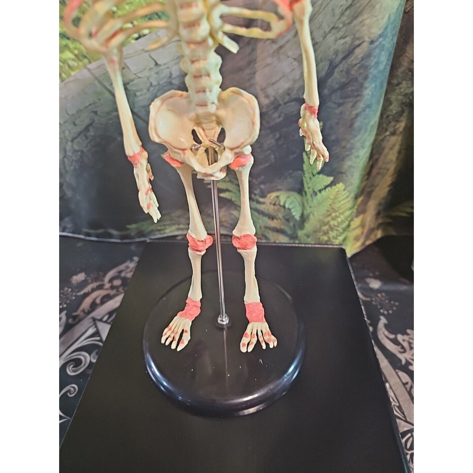 Pinyl vinyl chloride skeleton of abnormal infant