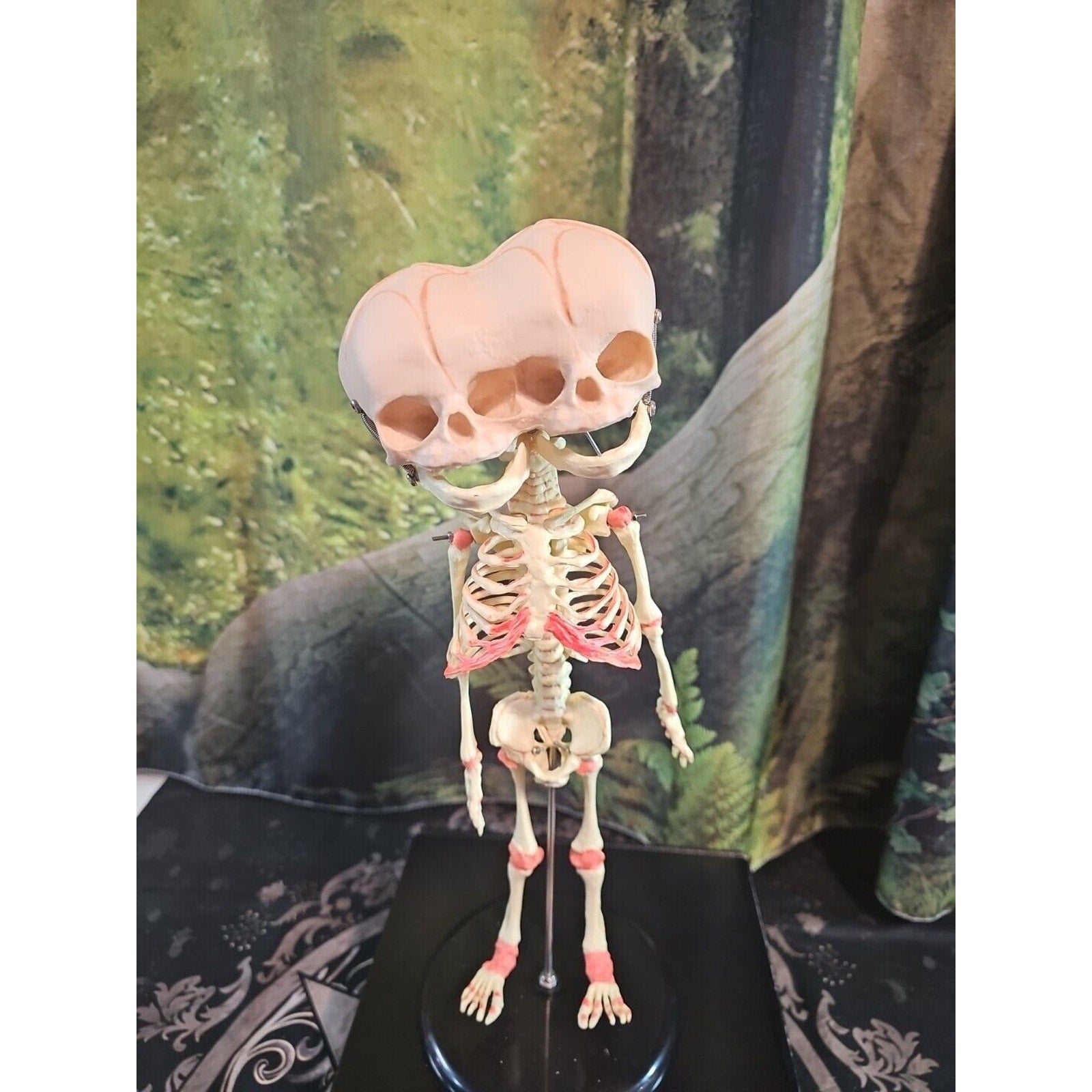 Pinyl vinyl chloride skeleton of abnormal infant