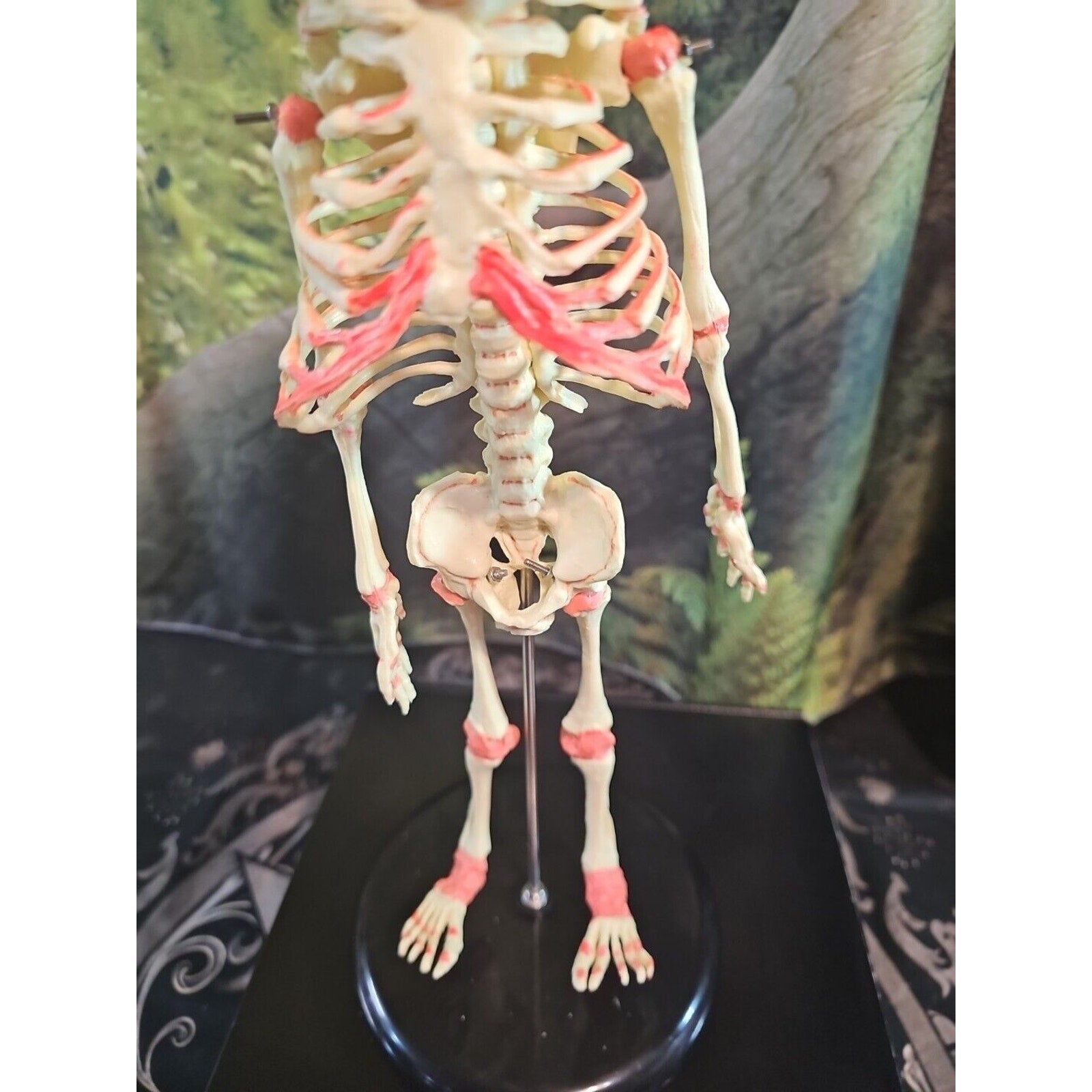 Pinyl vinyl chloride skeleton of abnormal infant