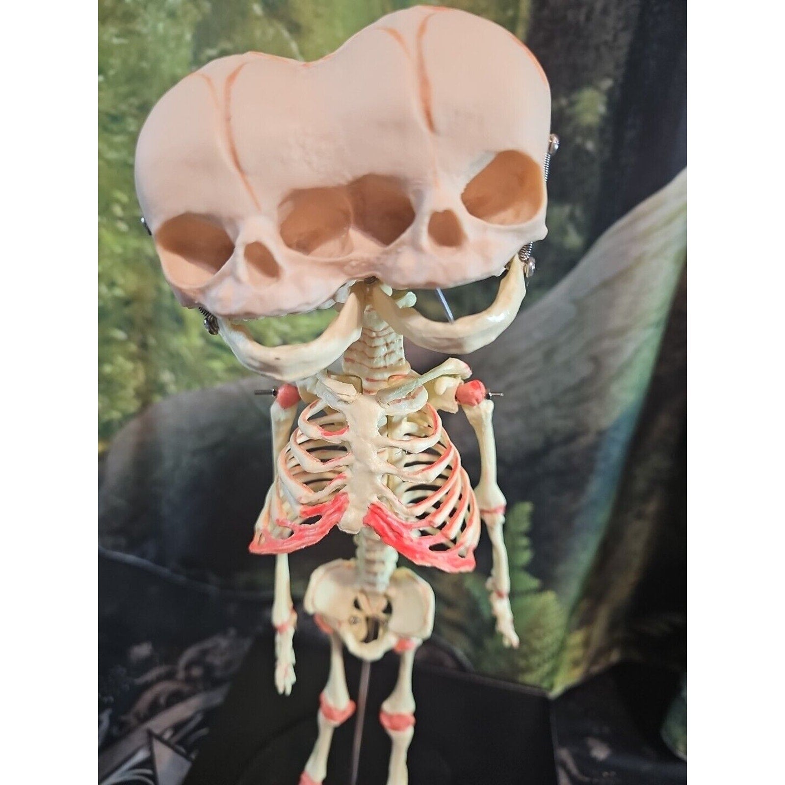 Pinyl vinyl chloride skeleton of abnormal infant