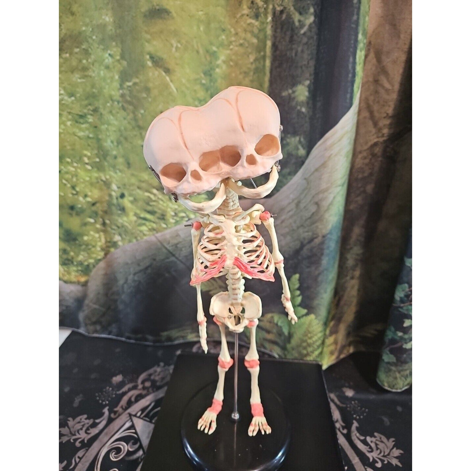 Pinyl vinyl chloride skeleton of abnormal infant