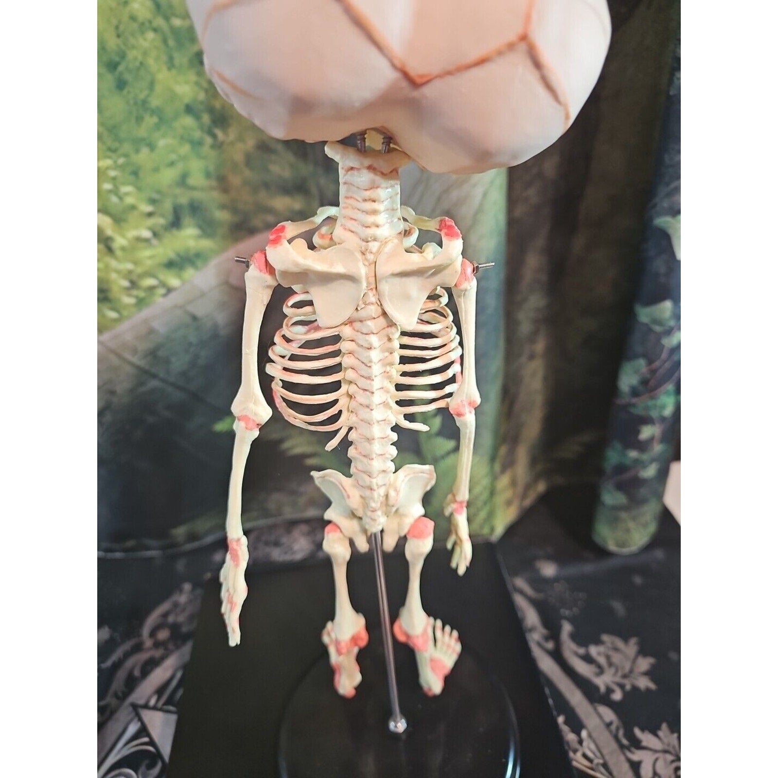 Pinyl vinyl chloride skeleton of abnormal infant