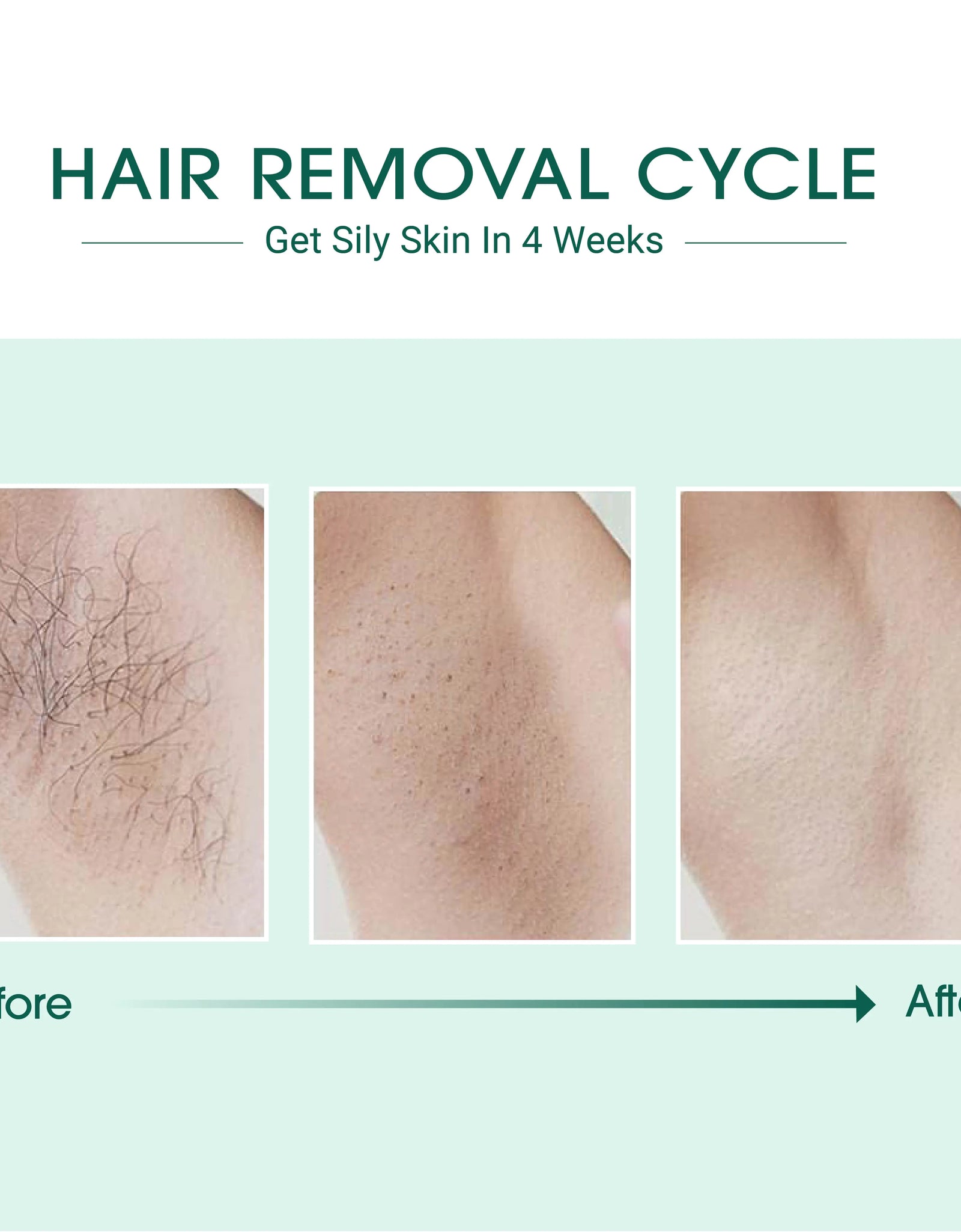 Laser IPL Hair Removal